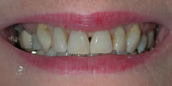 before veneers