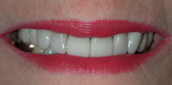 after veneers