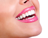 smile photo (veneers)
