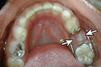 erupting tooth