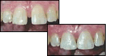 before and after dental bonding