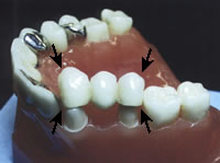 dental bridge