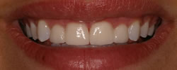 before Gum Contouring