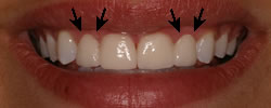 after Gum Contouring