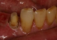 before Crown Lengthening
