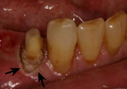 after Crown Lengthening