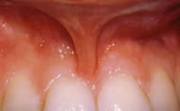 before frenectomy
