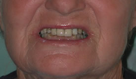 Before Full Mouth Reconstruction