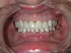 After Full Mouth Reconstruction Front View