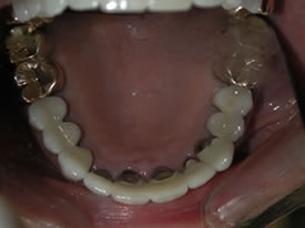 After Full Mouth Reconstruction Top View