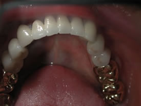 After Full Mouth Reconstruction Bottom View