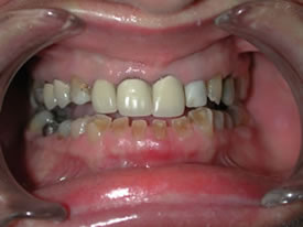 Before Full Mouth Reconstruction Front View