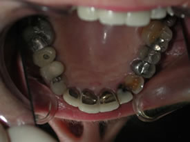 Before Full Mouth Reconstruction Top View