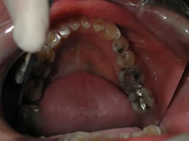 Before Full Mouth Reconstruction Bottom View
