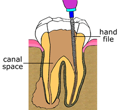 Root Canal Therapy