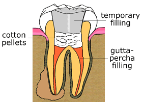 Temporary Filling