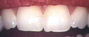 before shaping