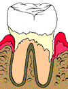 Tooth before scaling and root planing