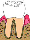Tooth after scaling and root planing
